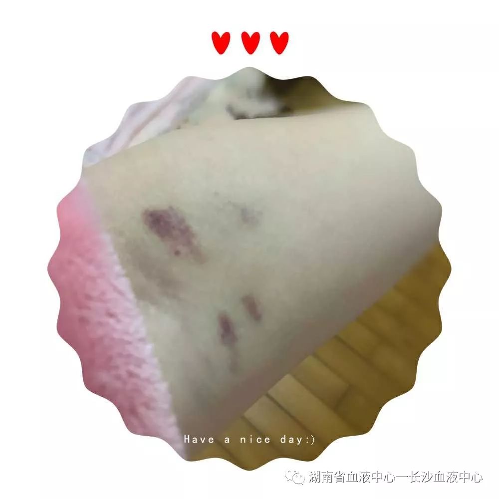 献血后手变“黑”了？Why?