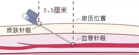 献血后你知道怎么按压针眼吗？