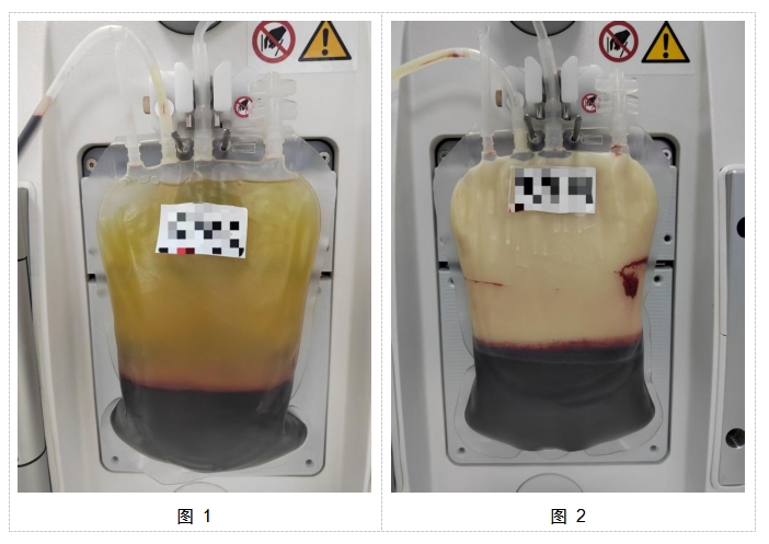 乳糜血:隐藏在血液中的警报器